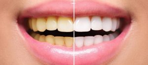 Como evitar dentes amarelados e ter um sorriso saudável 5