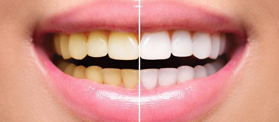Como evitar dentes amarelados e ter um sorriso saudável 1